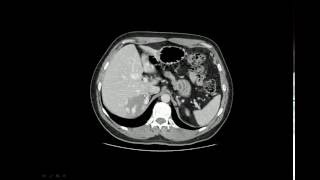 Hemangioma hepático na TC [upl. by Odama]