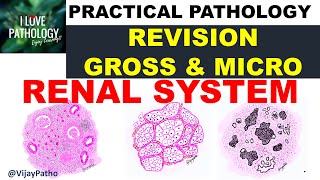 Practical Pathology Renal system Chronic pyelonephritis RCC amp Wilms tumor [upl. by Jorrie]