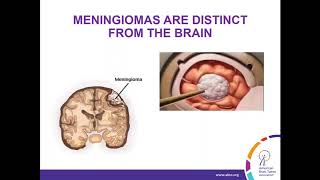 WEBINAR Treatment Strategies for Meningioma [upl. by Ynalem]