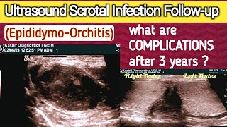 Chronic Scrotal Infection  Complications  Male Infertility  Epididymo Orchitis [upl. by Callas]