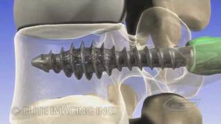 Spine Fixation  Medical amp Scientific Video Production [upl. by Enyledam550]