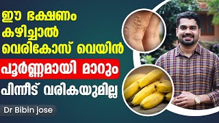 ഈ ഭക്ഷണങ്ങൾ കഴിച്ചു വെരികോസ് വെയ്ൻ പൂർണമായി മാറ്റം Vericose Treatment in Malayalam Dr Bibin Jose [upl. by Tnelc]