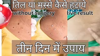 How To Remove Moles and Warts Naturally in hindi step by step No Surgery [upl. by Sacksen]