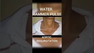 WATER HAMMER PULSEAortic REGURGITATION [upl. by Sherwood]