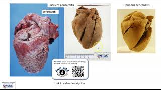 Heart Purulent pericarditis Gross pathology [upl. by Aerdua220]