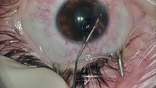 Iris reconstruction in a phakic patient [upl. by Arika]