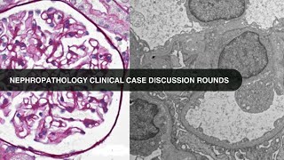 2017 03 16 Nephropathology Clinical Case Discussion Rounds [upl. by Malinowski25]