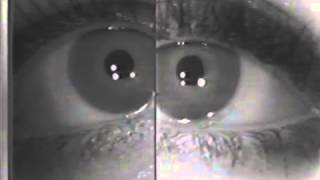 Horners syndrome Dilation Lag [upl. by Quackenbush]