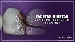 Facetas Diretas com Resinas Compostas e Pigmentos  Leonardo Muniz [upl. by Airamasor]