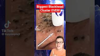 BIGGEST BLACKHEADS REMOVAL EVER  Extreme Blackheads on Cheek shorts [upl. by Rogerson]