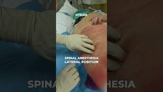 Spinal is best in sick patients anesthesia nerveblock [upl. by Yong]