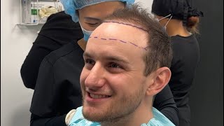 How to decide your Hair Transplant hairline height PT2￼ [upl. by Idoj]