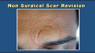 Non Surgical Scar Revision with Cannula amp Laser For Enquiry Contact 970002 0802 [upl. by Ahsats]