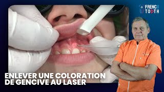 Comment enlever coloration de Gencive au Laser   Frank Pourrat [upl. by Werby]