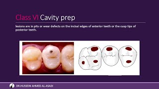 Dental Caries amp Class Of Cavity شرح التسوس ونوع الكلاسات [upl. by Mastic483]