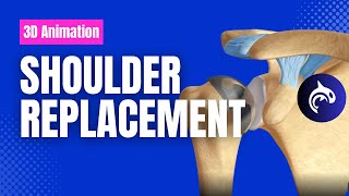 Shoulder Replacements Total vs Reverse vs Partial [upl. by Eixam624]