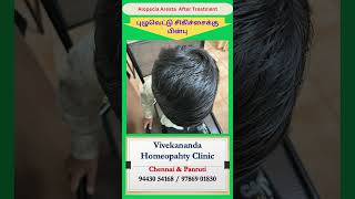 Alopecia area before and after treatment at Vivekananda Clinic [upl. by Ahsaeit780]