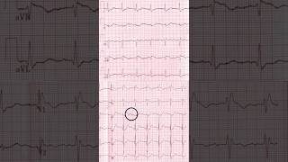 First degree AV block RBBB amp LAFB ECG [upl. by Hairom]