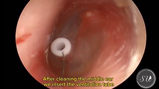 Myringotomy and Ear tube insertion by Dr Uluyol Orta kulağa ventilasyon tüpü takılması [upl. by Dosh]