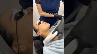 Luz pulsada intensa IPL laser lasercutting ipl luzpulsada skincare tratamientofacial [upl. by Omolhs]