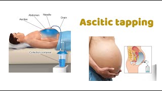 Ascitic Tap  StepbyStep Guide  How to do Ascitic tap  Pigtail Drainage  Peritoneal Tapping [upl. by Marba]