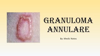 Granuloma annulare  associated conditions mechanism [upl. by Cathee124]