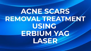 Vanish Scars Embrace Radiance Acne Scar Laser Removal acnescarremoval lasermachine [upl. by Cony]