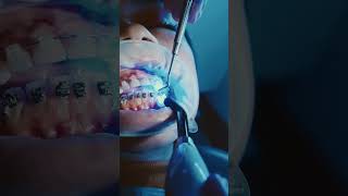 Orthodontics Procedure braces ceramic dentistry dental educational [upl. by Cirdla]