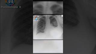 Radiographie thoracique chest xray radiologiest radiographie [upl. by Peltier790]