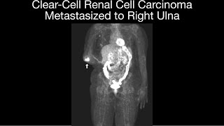 ClearCell Metastatic Renal Cell Carcinoma to Ulna [upl. by Belle]