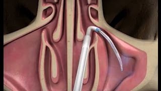 Balloon Sinuplasty Procedure with ENT Dr Timothy Ragsdale [upl. by Moir]