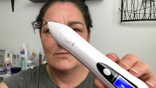 Fibroblast treatment At Home [upl. by Erund]