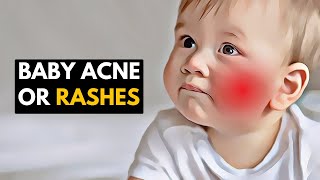 Gentle Care for Little Faces Managing Baby Acne and Rashes [upl. by Ttesil]