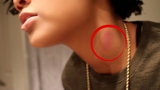 Hickey Prank on Girlfriend Goes Violent [upl. by Heshum219]