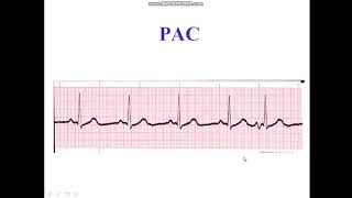 Premature Atrial Complex  Bigeminy  Trigeminy [upl. by Nav]