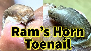 Rams Horn Toenail Severe Fungal Toenail [upl. by Ykroc]