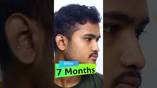 Hair Regrowth in 7 Months hairregrowth hairgrowth hairtutorial shorts [upl. by Head]