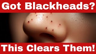 How to Remove Blackheads  Easy Steps for a Clear Skin [upl. by Suryt]