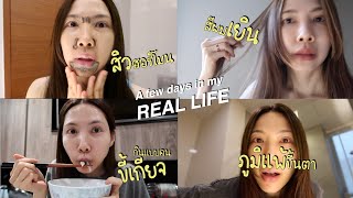 LIFE สิวฮอร์โมน สีผมเยิน ขี้เกียจ ภูมิแพ้ขึ้นตา ชีวิตจริงแบบเรียลๆ🫣🫠🫢 [upl. by Smalley432]