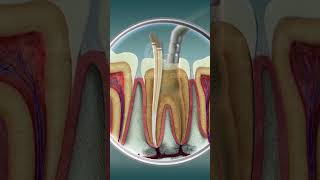 Root Canal Treatment  Curveia Dental I RCT [upl. by Belac183]