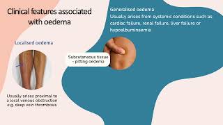 Clinical presentation of oedema [upl. by Enirehtahc573]