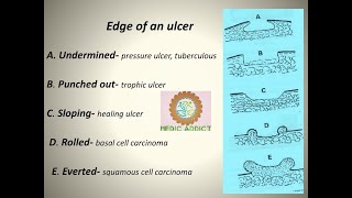 EDGES OF ULCER MNEMONICS  DETAILED EXPLANATION OF EDGES OF ULCER [upl. by Buzz174]