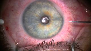 Stephen Slade MD Image Guided LASIK Flaps [upl. by Aihsema]