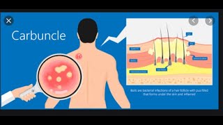 Treatment and Prevention of Staphylococcus Aureus part2 [upl. by Adnilreb588]