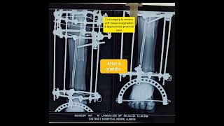 ilizarov surgery bone transport radiological progress [upl. by Iggep]