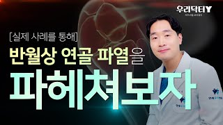 반월상 연골 파열 실제 수술 사례를 통해 마구마구 파헤쳐보자 [upl. by Rorrys]