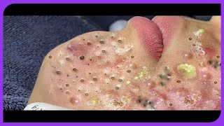 Blackhead Removal Extreme Blackheads Extraction 2024 [upl. by Ayotac]