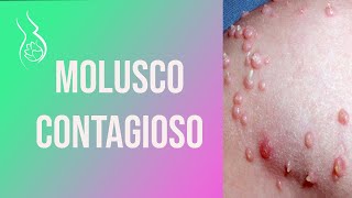 MOLUSCO CONTAGIOSO 😱 [upl. by Tekcirc]