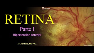 Clase de Retina Parte I Hipertensión Arterial Retinopatía Hipertensiva [upl. by Resiak]