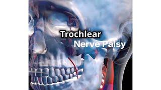 Trochlear Nerve Palsy  English [upl. by Astri]